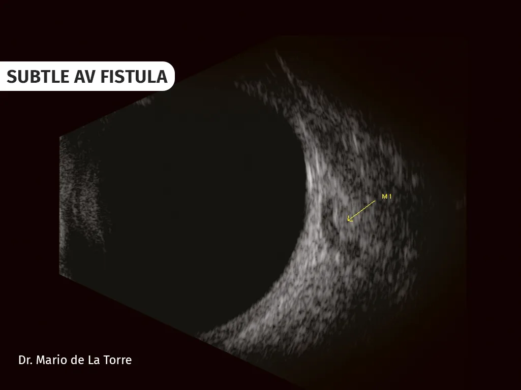 Quantel Medical Compact Touch — Что видно на B-сканах — фото 4