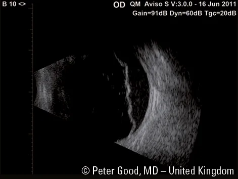 Quantel Medical Aviso — Сканы с датчиков платформы — фото 1