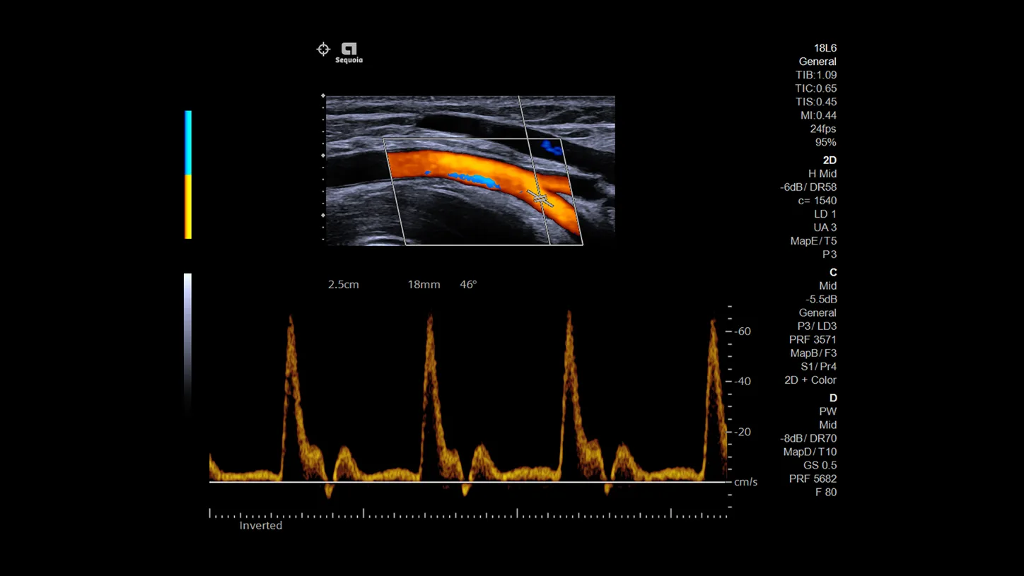 Siemens ACUSON Sequoia — Auto TEQ Doppler
