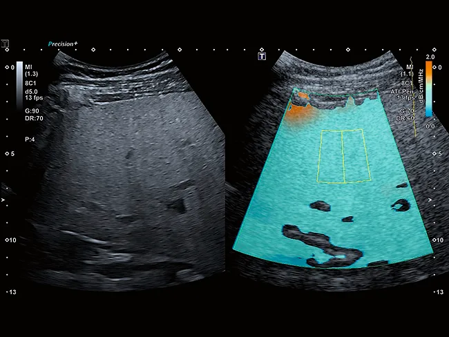 Canon Aplio a — Attenuation Imaging: стеатоз печени в числах
