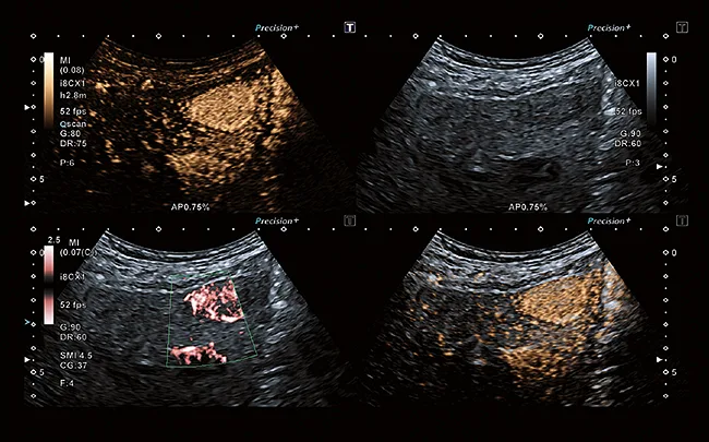 Canon Aplio i800 — Superb Micro-vascular Imaging (SMI)