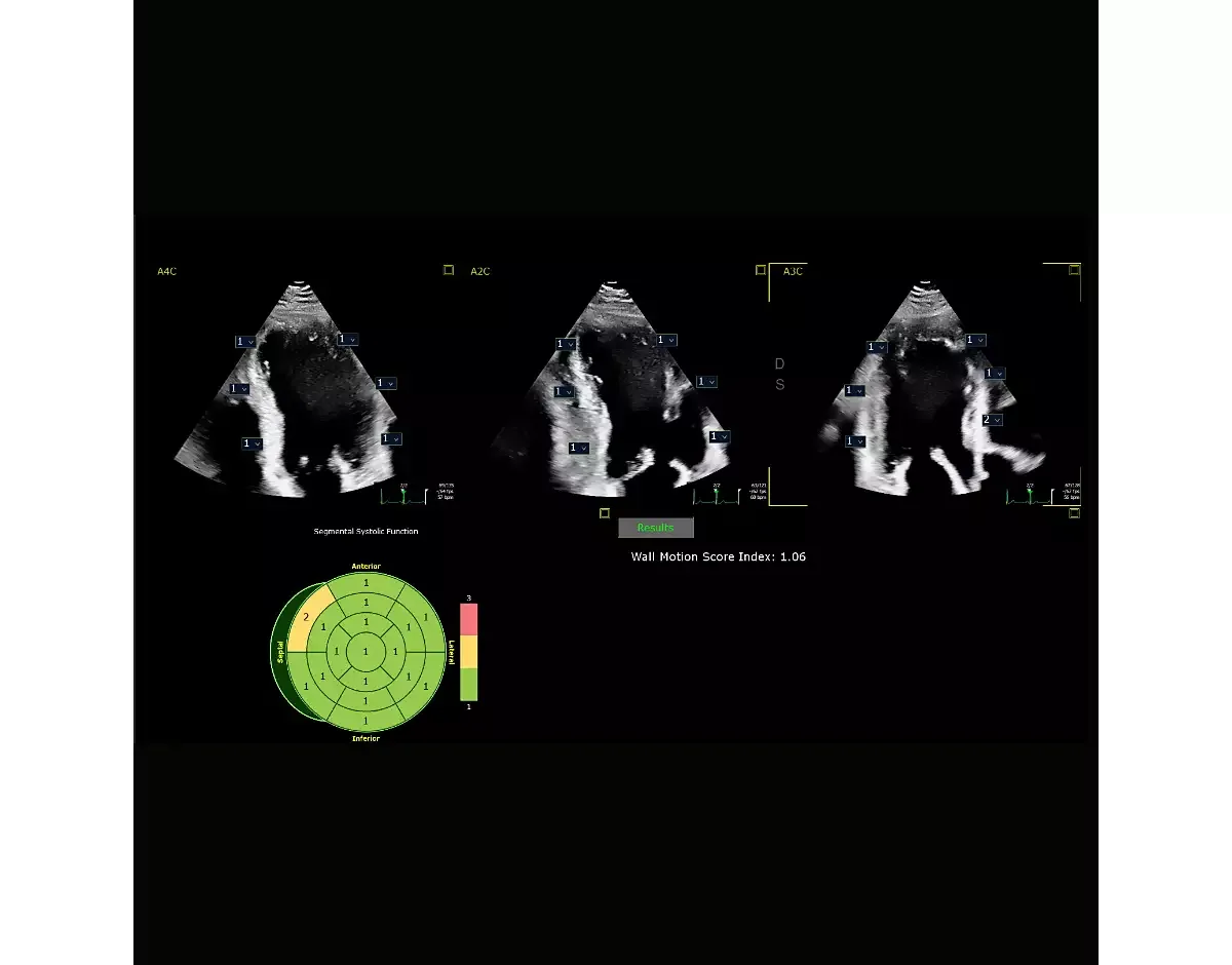 Philips Affiniti 50 — Auto Segmental Wall Motion Scoring