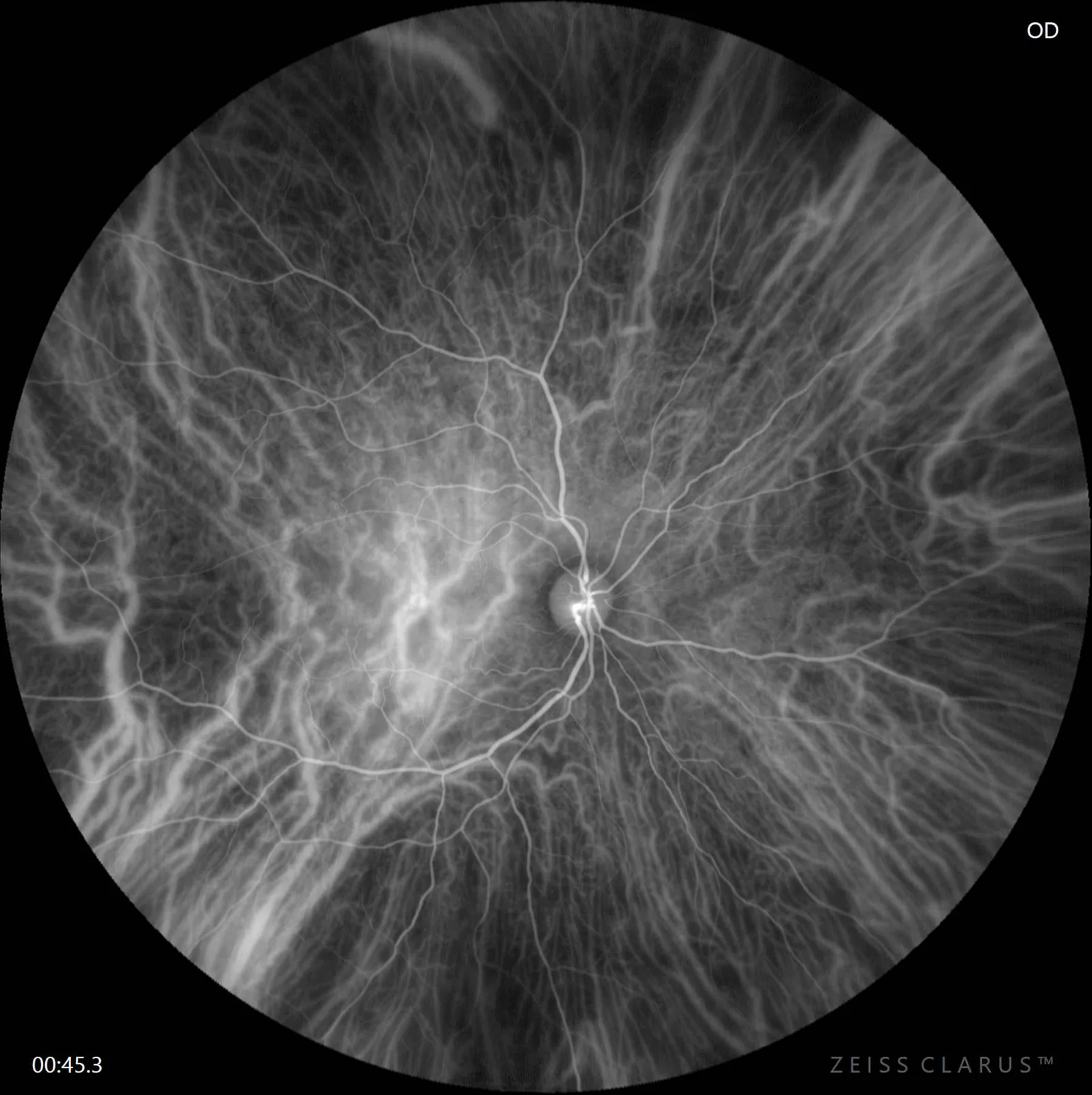 ZEISS CLARUS 700 — Ангиография: ФАГ и ИЦЗА одновременно