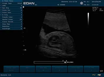 EDAN U2 Prime Edition — Экран системы и клинические примеры — фото 12