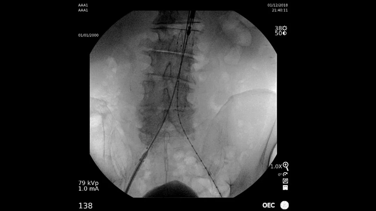 GE HealthCare OEC Elite CFD — Снимки, сделанные на OEC Elite — фото 5