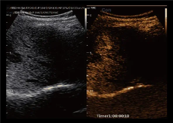 CHISON CBit 9 — SonoContrast: микроциркуляция с контрастом