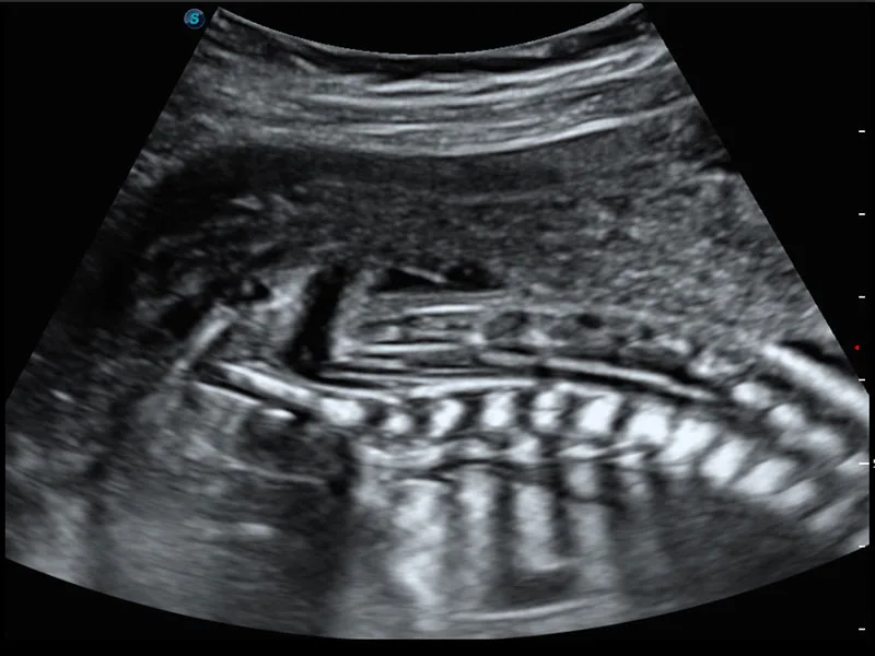 SonoScape S60 — Клинические изображения, снятые на S60 — фото 8