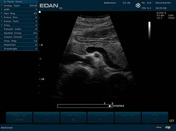 EDAN U2 Prime Edition — Экран системы и клинические примеры — фото 14