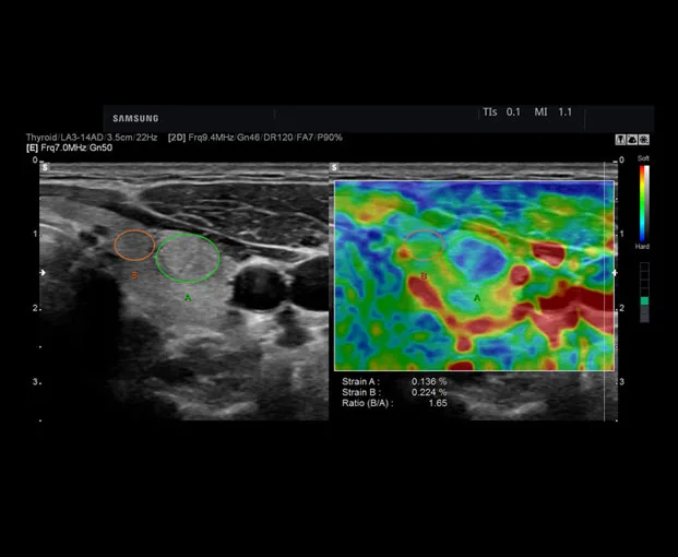 Samsung HS50 — Эластография: ElastoScan и E-Strain