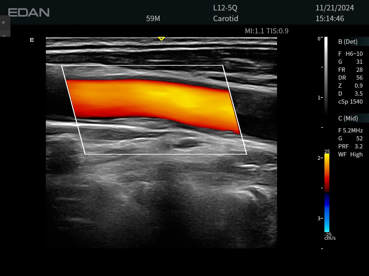 EDAN Acclarix LX85 — Клинические изображения Acclarix LX85 — фото 2