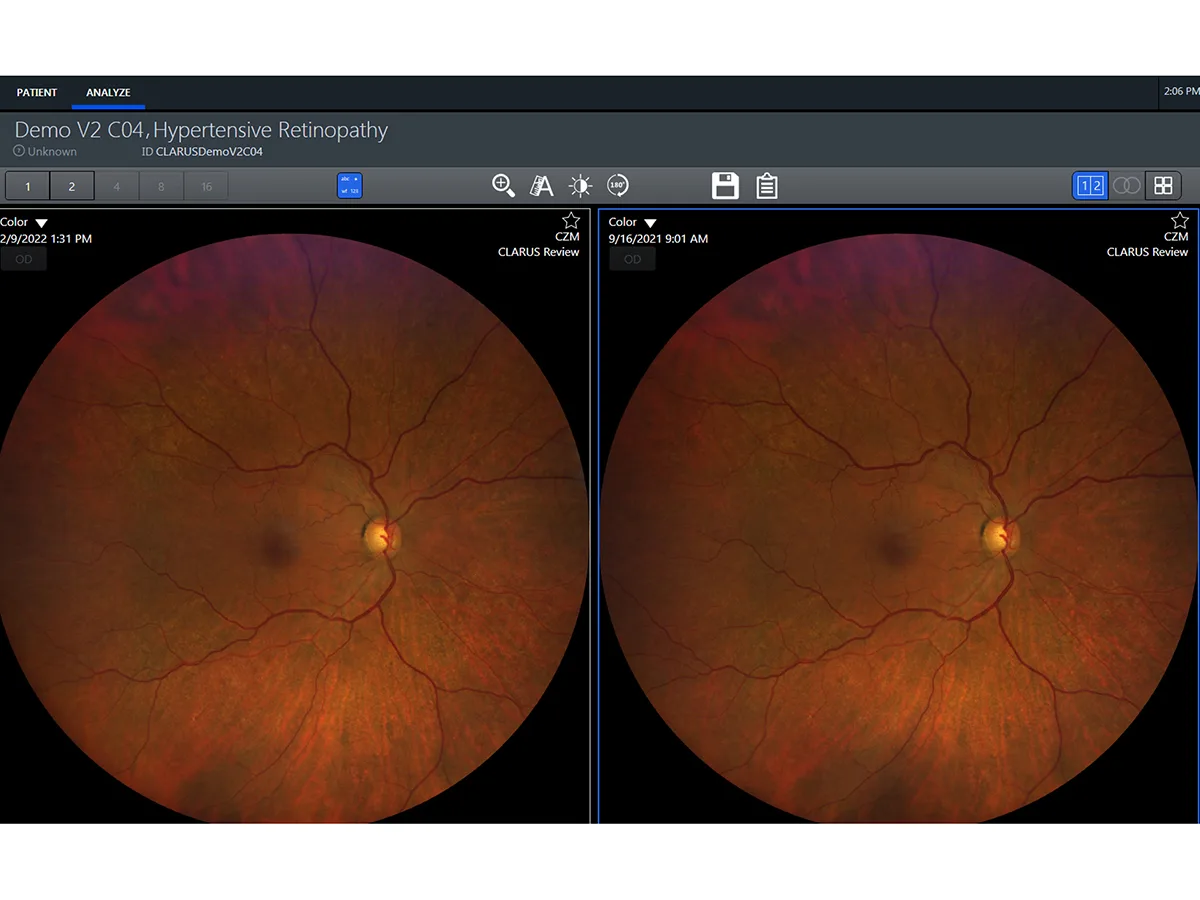 ZEISS CLARUS 700 — Автоматика, которая экономит время у прибора — фото 4