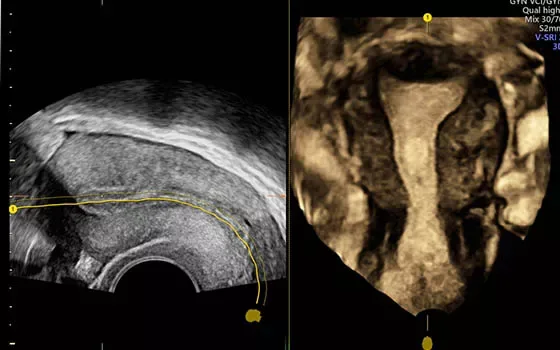 GE Voluson E10 — Uterine Trace и HDRes