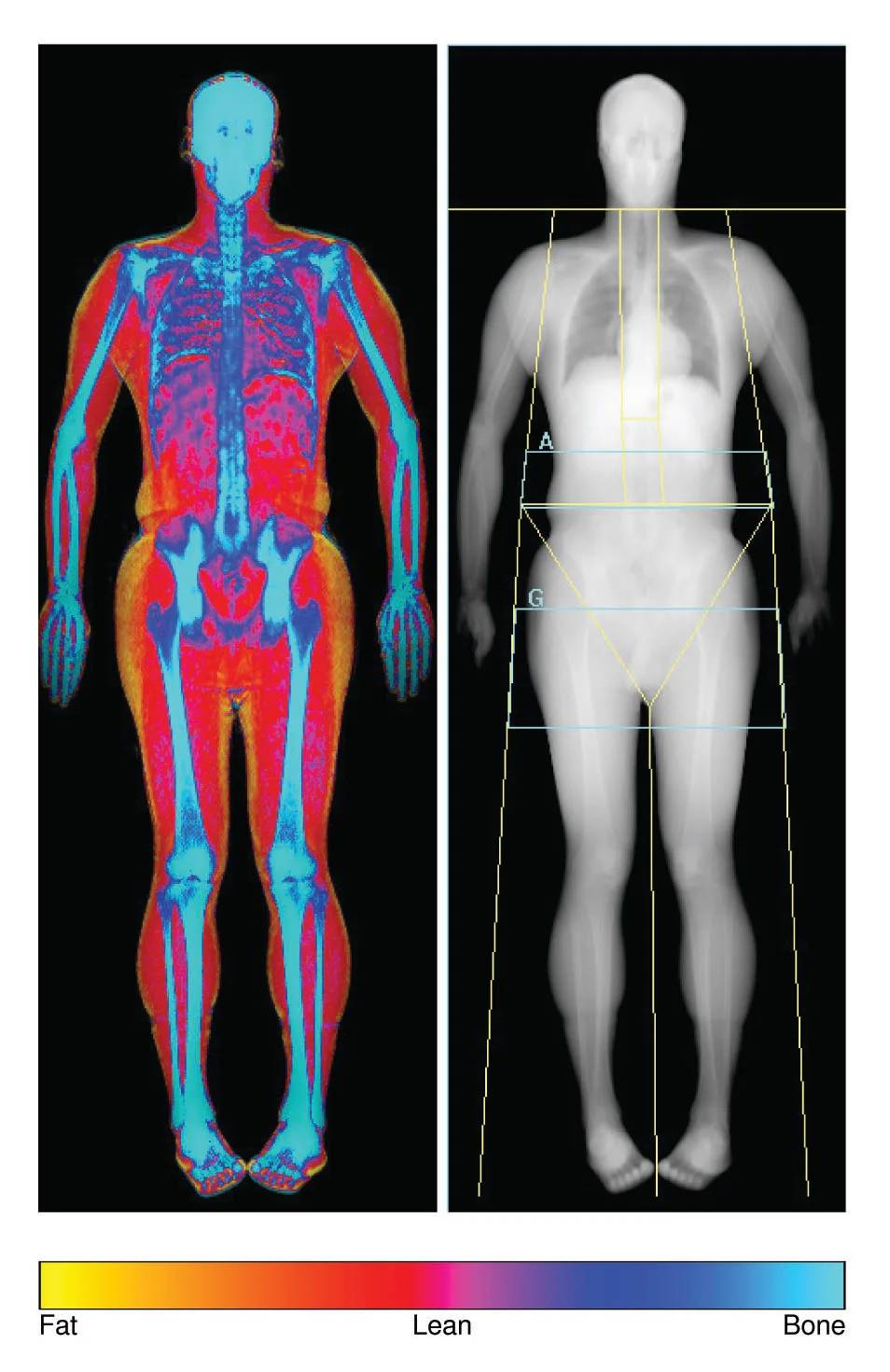 Hologic Discovery — Состав тела и висцеральный жир