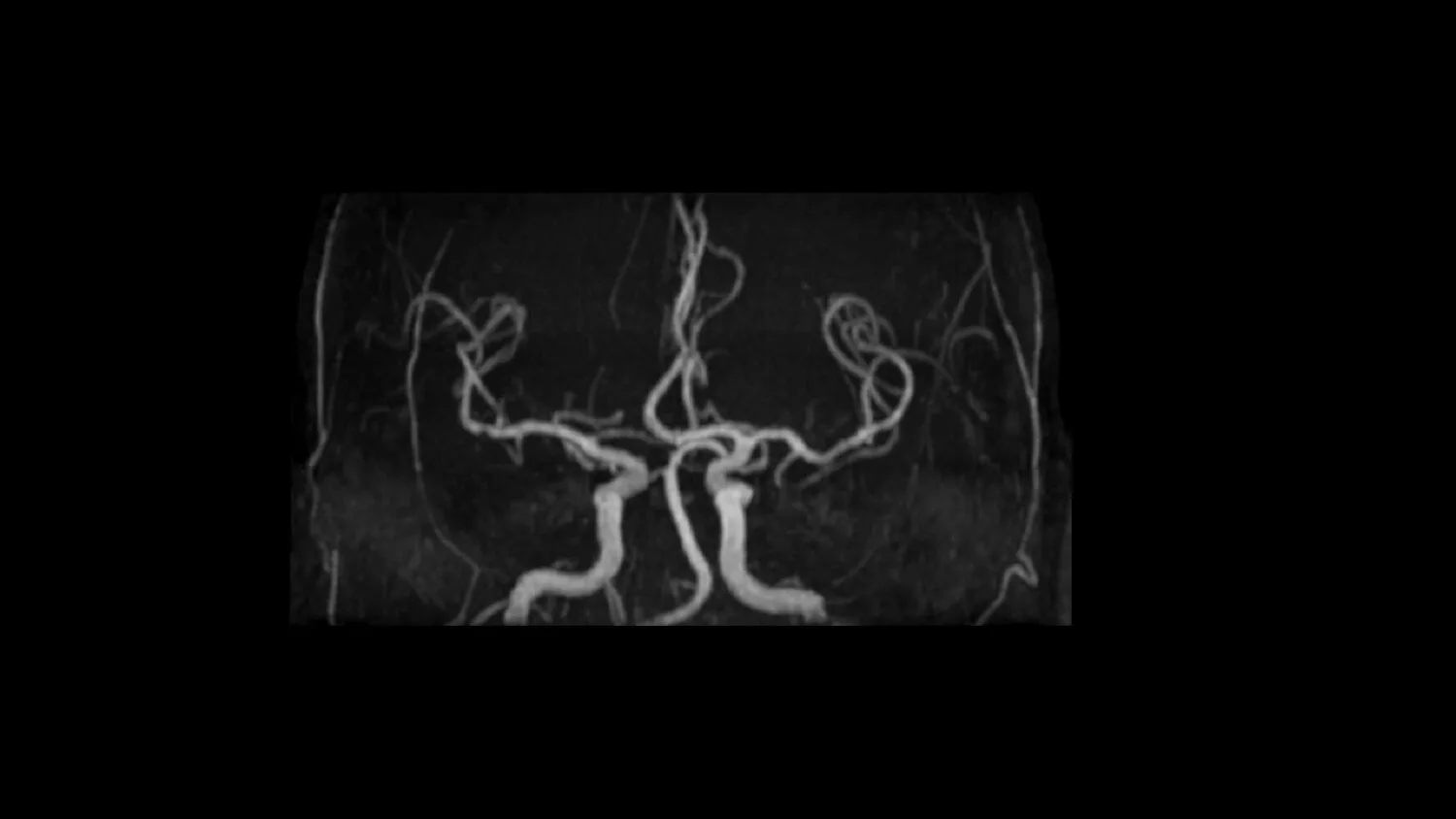 GE HealthCare SIGNA Explorer 1.5T — HyperSense: сжатые измерения в рутине — фото 2