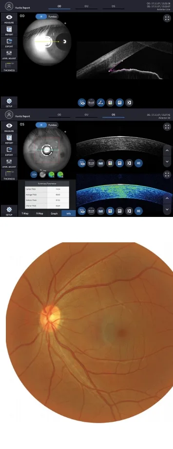 Huvitz HOCT-1F — Передний отрезок двумя адаптерами