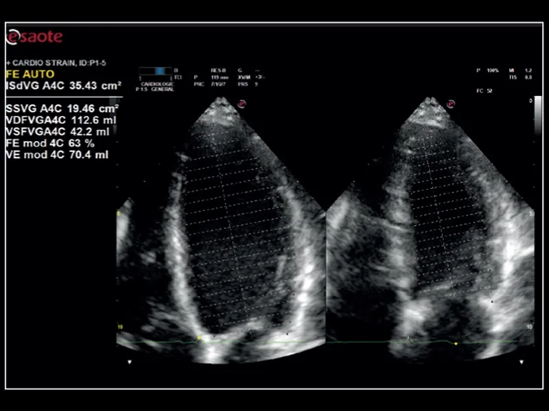 Esaote MyLab X8 — Кардиология: AutoEF, XStrain 2D и 4D, QIMT — фото 1