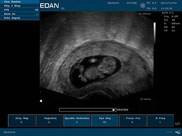EDAN U50 Prime Edition — Клинические изображения U50 Prime Edition — фото 1