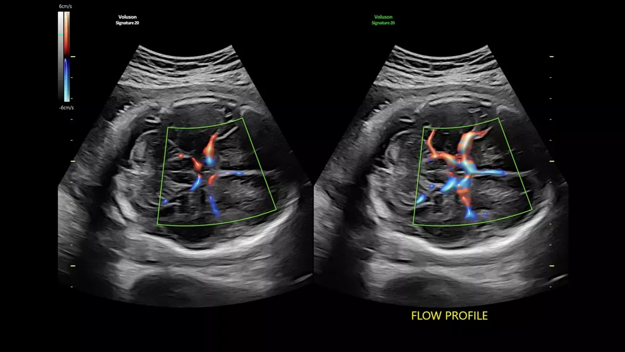GE Voluson Signature 20 — Flow Profiles и Spine Trace: меньше нажатий