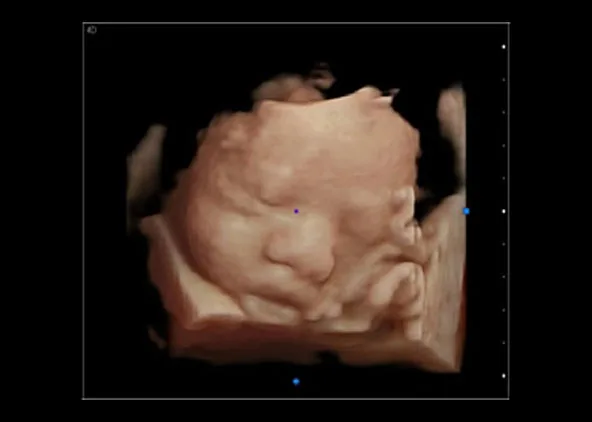 CHISON SonoBook 9 — Virtual HD: лицо плода в 4D