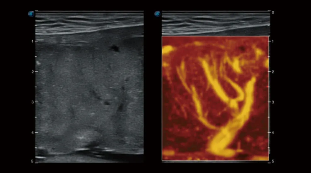 SonoScape P50 Elite — μScan+, SR-Flow, Micro F и Bright Flow — фото 3