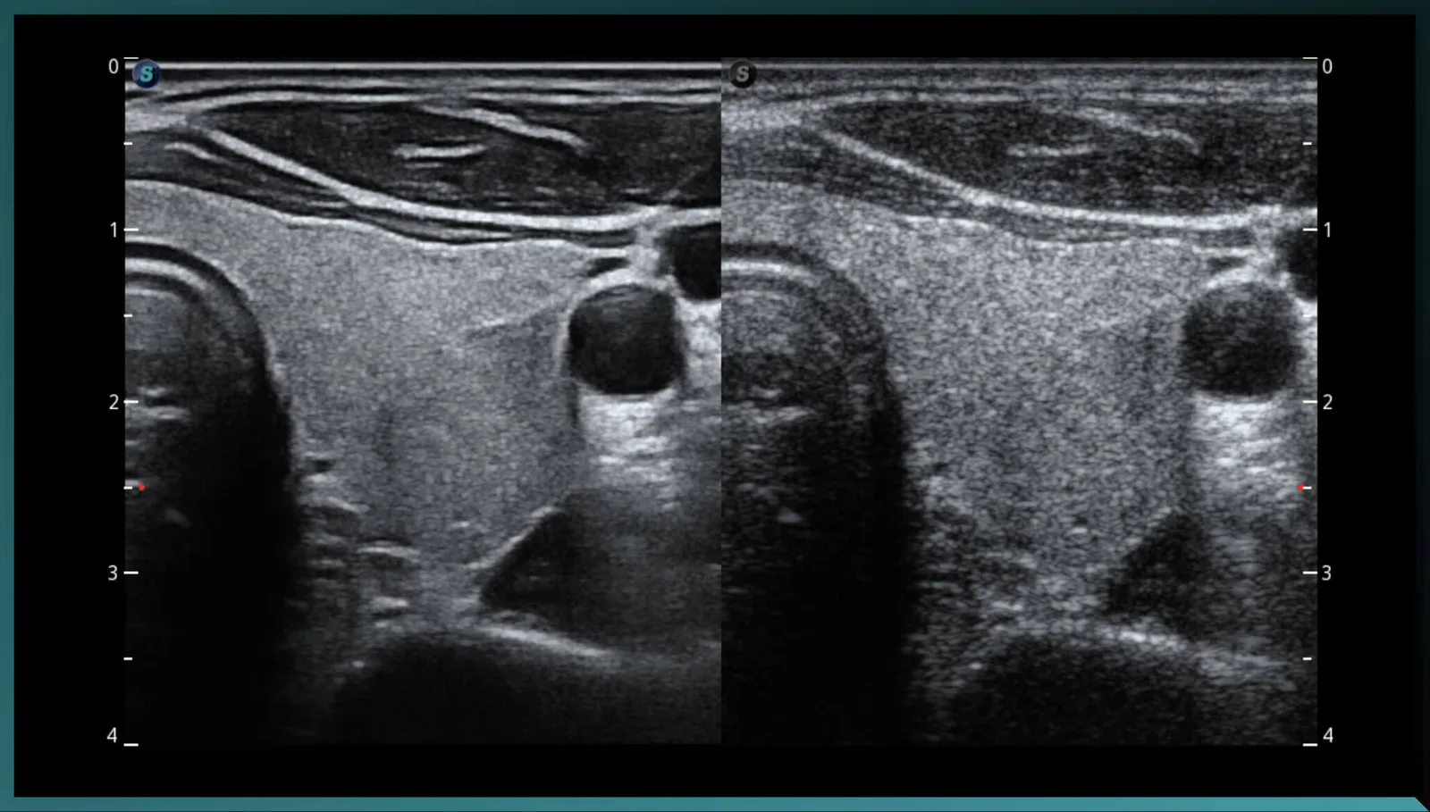 SonoScape S50 Elite — μScan+, SR-Flow, Micro F и Bright Flow — фото 1