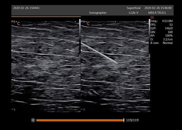 CHISON SonoBook 9 — Super Needle: подсветка иглы
