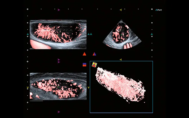 Canon Aplio i800 — Superb Micro-vascular Imaging (SMI)