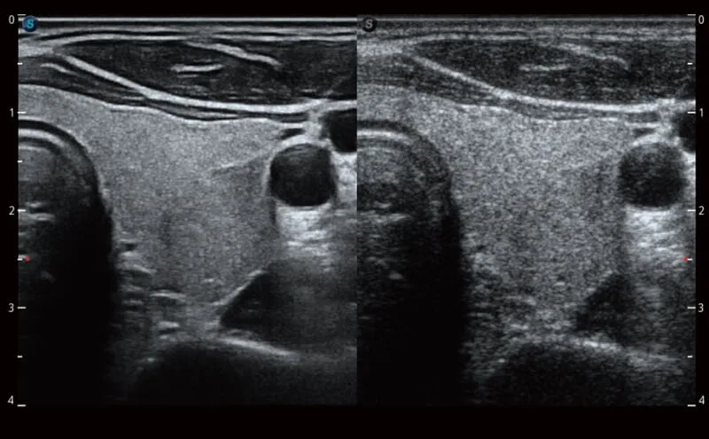 SonoScape P40 Elite — μ-Scan+, SR-Flow и Micro F: чистая картинка