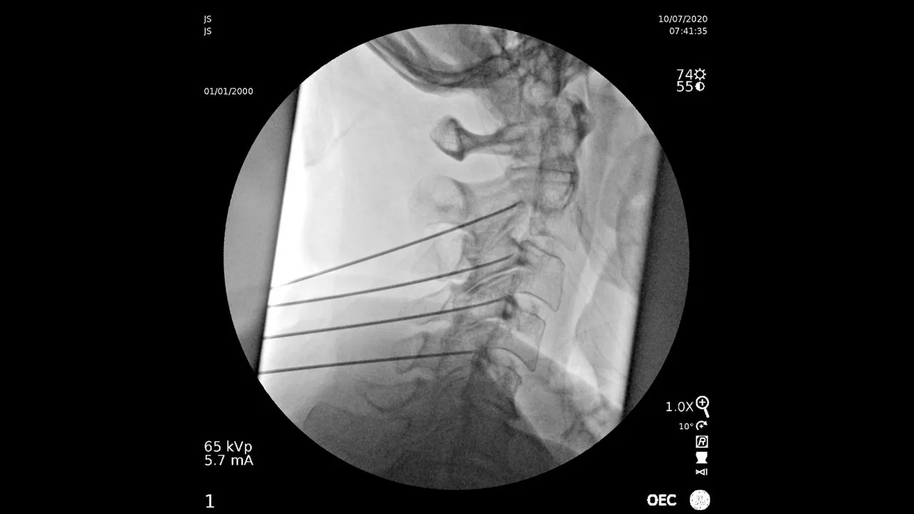 GE HealthCare OEC Elite CFD — Снимки, сделанные на OEC Elite — фото 6