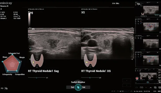 Mindray Resona I9 — Smart Thyroid — стандартизированная оценка узлов