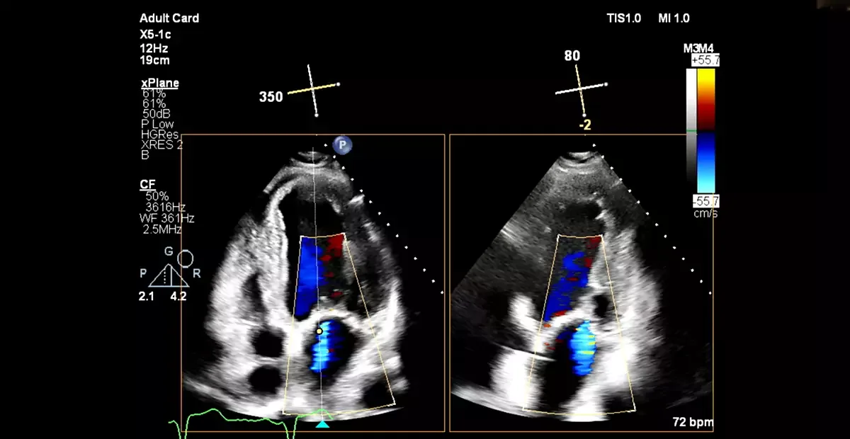 Philips EPIQ CVx — Клинические изображения EPIQ CVx — фото 5