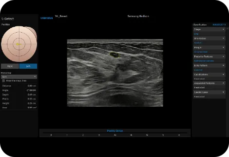 Samsung V6 — S-Detect Breast: классификация по BI-RADS