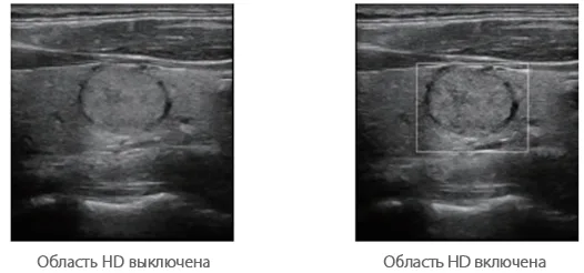 Mindray Resona 6 — Улучшенная обработка канальных данных