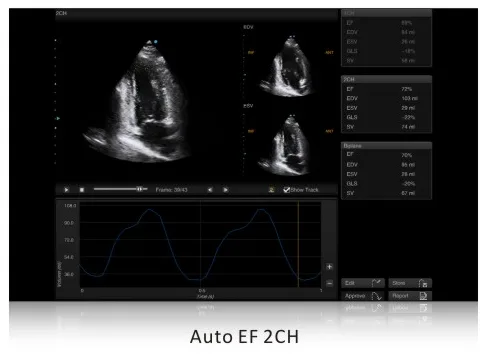 SIUI Apogee 5500 — Auto EF: фракция выброса в рутинной практике