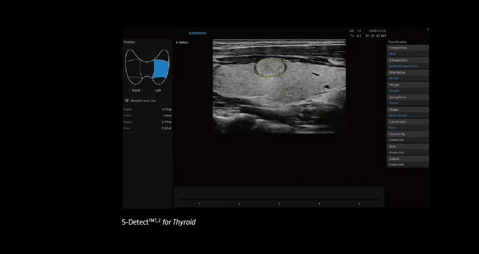Samsung RS85 — S-Detect Thyroid: пять шкал TI-RADS