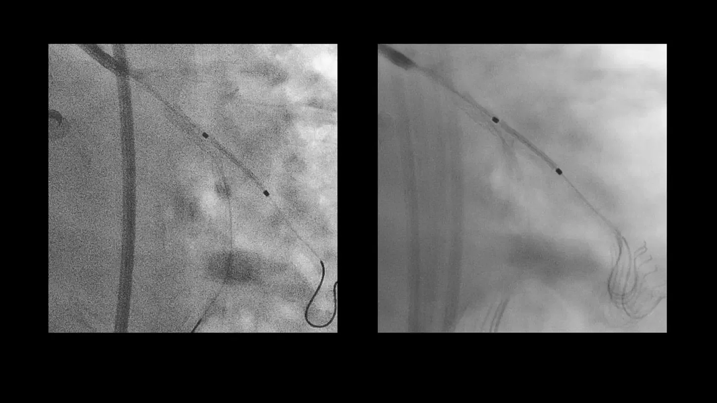 Siemens ARTIS one — CLEARstent Live: стент виден в реальном времени