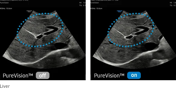 Samsung RS85 — PureVision: подавление спекл-шума