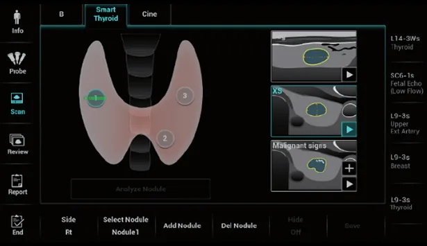 Mindray Resona I9 — Smart Thyroid — стандартизированная оценка узлов