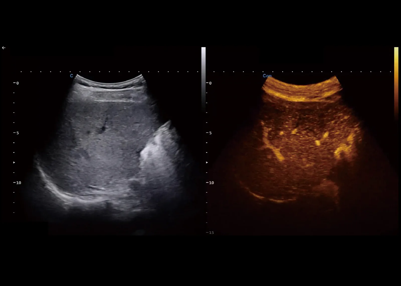 CHISON XBit 90 — SonoContrast: контрастные исследования