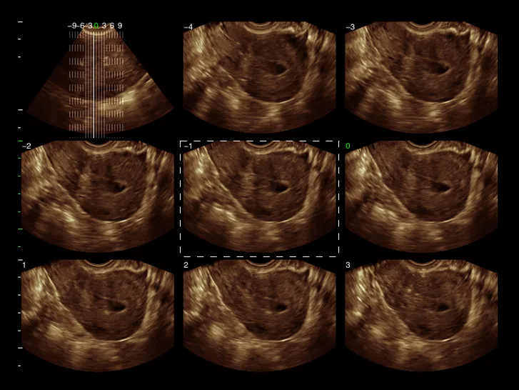 SIUI Apogee 3800 — Клинические изображения — фото 3