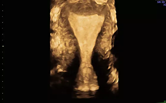 GE Voluson E8 — Объёмные инструменты: Advanced VCI и Uterine Trace