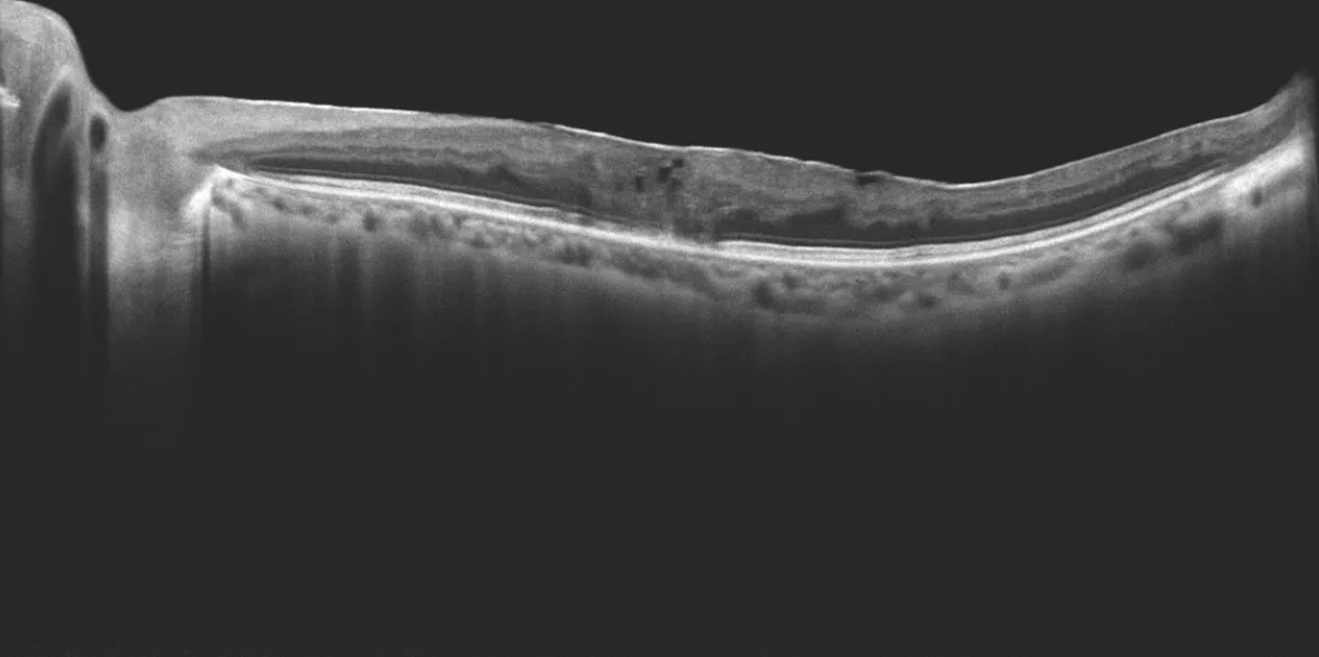 MOPTIM Mocean 3000 — Патологии сетчатки на снимках Mocean 3000 — фото 3