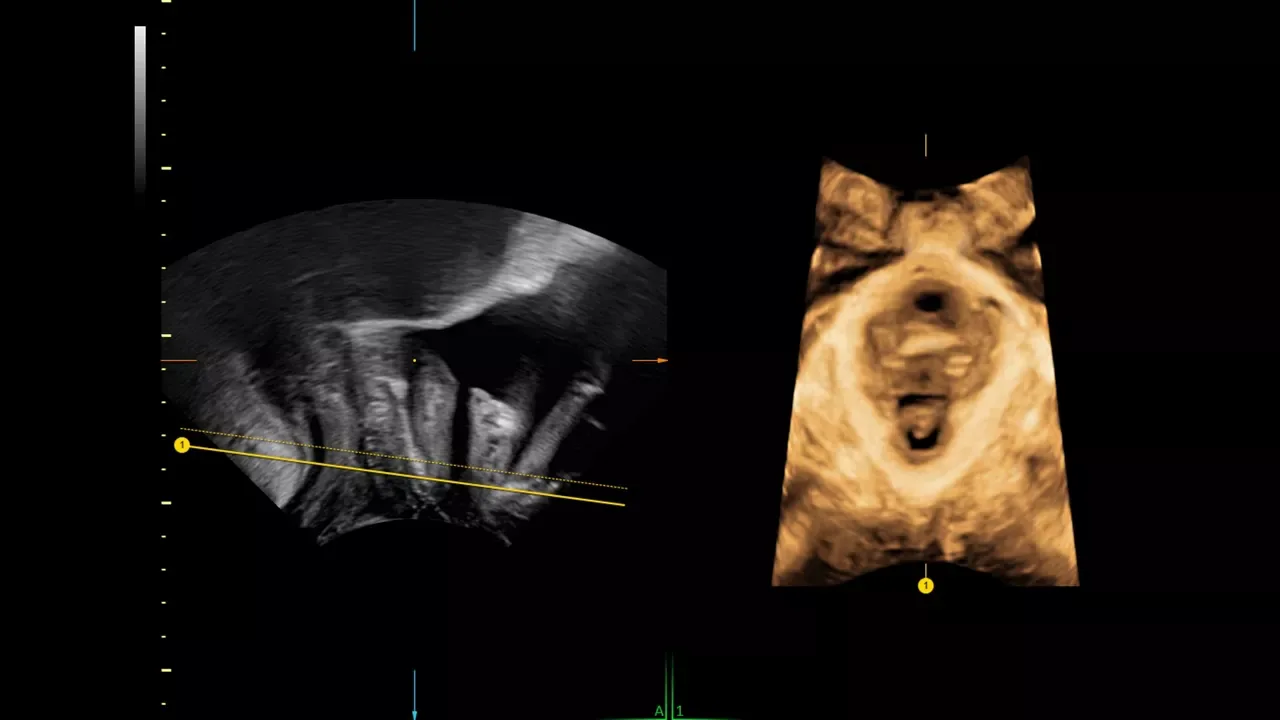 GE Voluson Signature 20 — SonoGYN и SonoPelvicFloor: гинекология по стандартам
