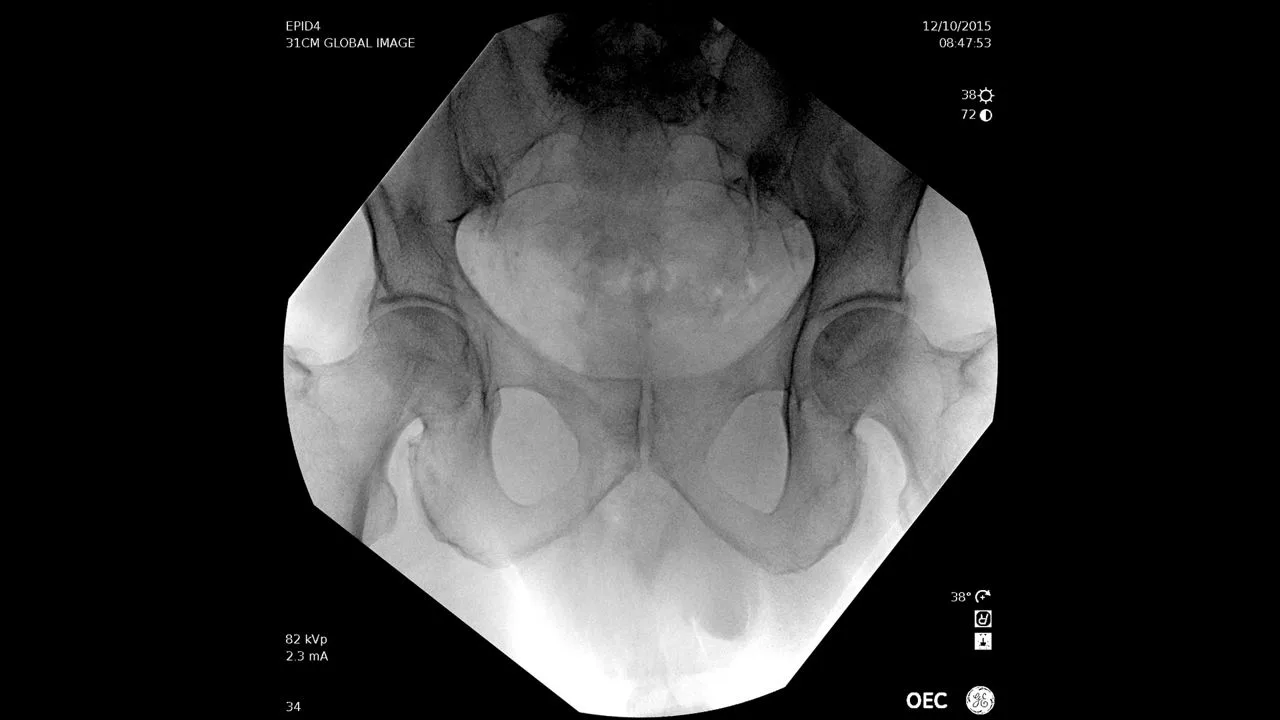 GE HealthCare OEC Elite CFD — Снимки, сделанные на OEC Elite — фото 1