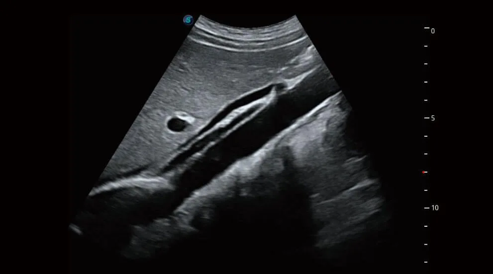 SonoScape P50 Elite — μScan+, SR-Flow, Micro F и Bright Flow — фото 1