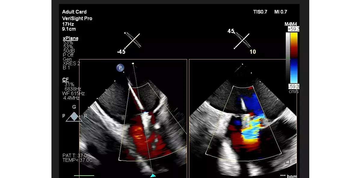 Philips EPIQ CVx — Клинические изображения EPIQ CVx — фото 8