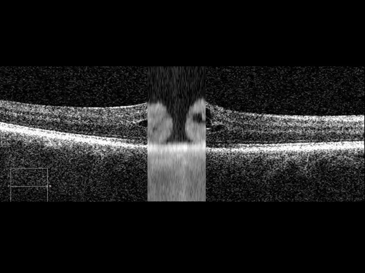 ZEISS IOLMaster 700 — Fixation Check: видна ли фовеолярная ямка