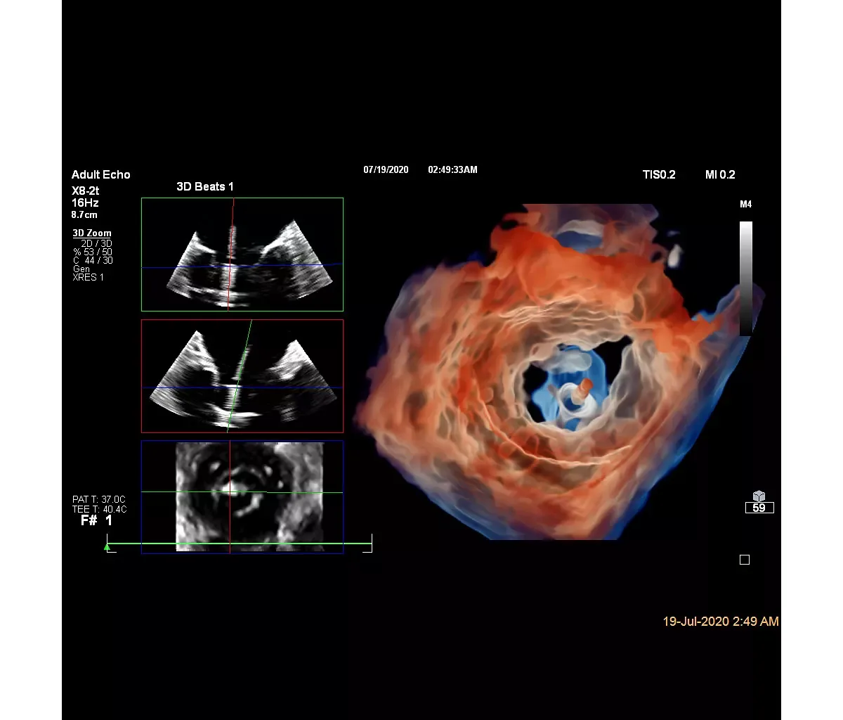 Philips EPIQ CVx — MultiVue и восстановление настроек