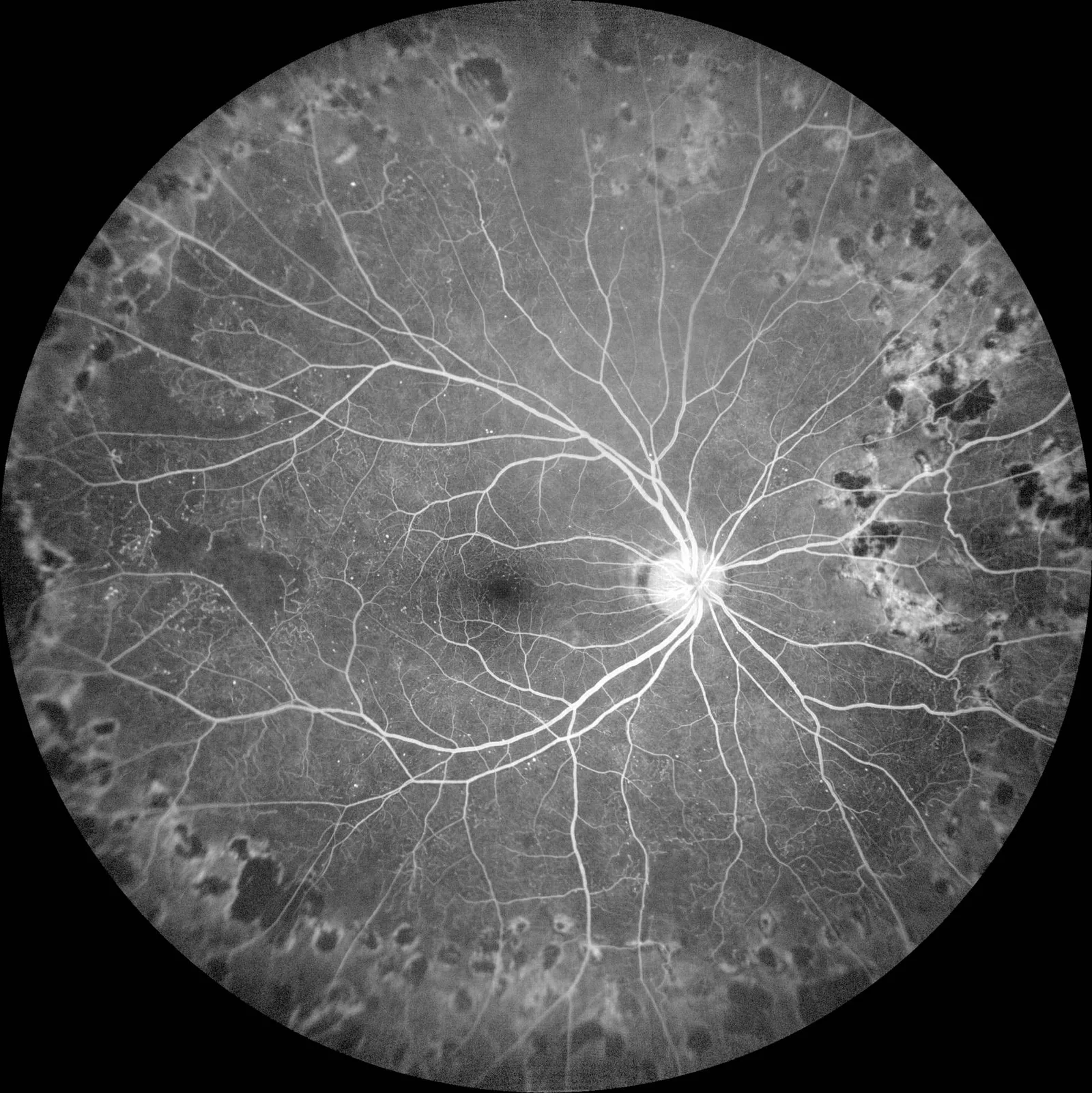 ZEISS CLARUS 700 — Ангиография: ФАГ и ИЦЗА одновременно