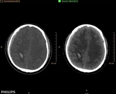 Philips IQon Spectral CT — Клинические исследования на IQon Spectral CT — фото 2